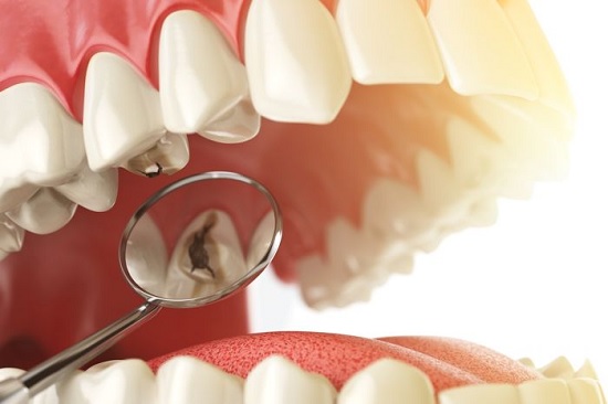 Tratamientos más comunes en los dientes